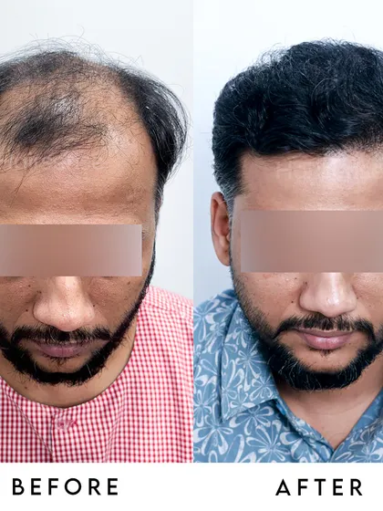 The top-down view clearly illustrates the extent of the restored coverage, turning a previously bald crown into a dense, healthy-looking scalp.