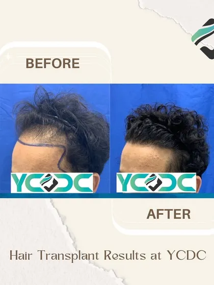 This side-profile before and after shows a successful hairline transformation, with the new hair styled to demonstrate its natural texture and density.
