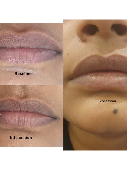 Treating dark lips requires patience and consistency. This progression over two sessions shows a gradual and natural lightening of lip pigmentation, restoring a more even and healthy color.