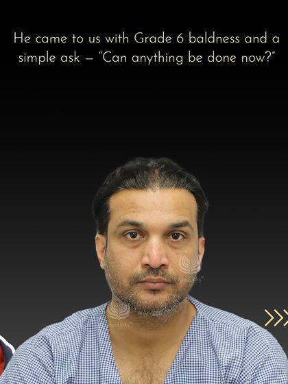 Mr. Manish came to us with advanced Grade 6 baldness, asking if anything could be done.