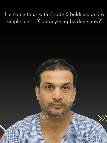 Mr. Manish came to us with advanced Grade 6 baldness, asking if anything could be done.
