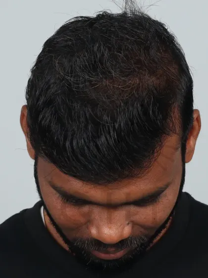 The end of Diffuse Grade 6 baldness. With a 5000-graft hair transplant, we achieved full coverage for the frontal hairline, mid-scalp, and crown.