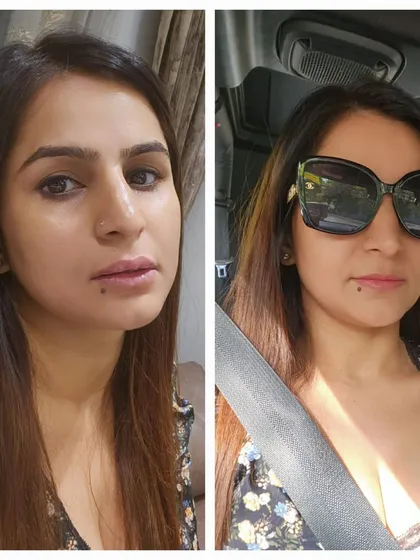 A happy client shares her before and after selfies just one hour after an upper lip filler treatment. The result is a subtle, natural enhancement that she loves.