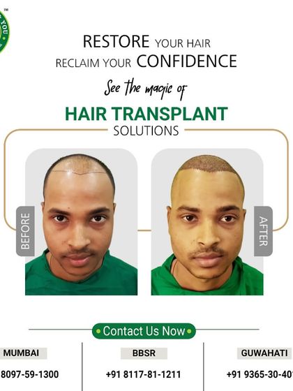 This before and after shot shows the immediate result post-surgery. You can see the density and placement of the grafts, which will grow into a full, natural head of hair over the coming months.