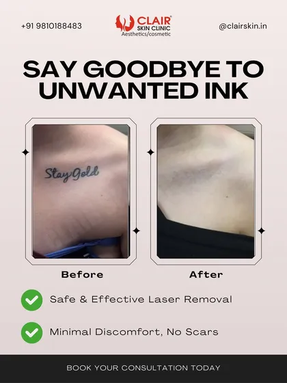 A fresh start for your skin is possible. This before and after shows the complete removal of a "Stay Gold" collarbone tattoo using our advanced laser technology. We effectively fade the ink until it's gone, leaving behind clear skin with minimal discomfort and no scarring.