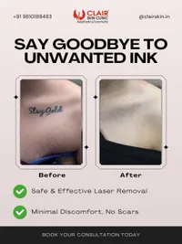 Tattoo & Skin Growth Removal