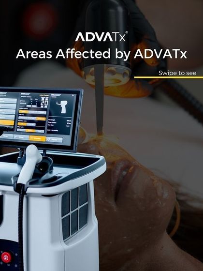 This graphic illustrates the areas affected by the AdvaTx laser. Its dual-wavelength technology allows it to treat both superficial issues in the epidermis and deeper concerns in the dermis for comprehensive skin restoration.
