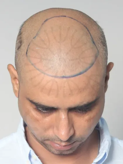 This shows the crucial first step: hairline design. We mark the area precisely to ensure the final result perfectly frames the face.