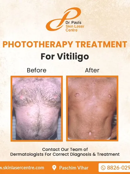 This before and after image shows the results of NB-UVB phototherapy on the chest and abdomen. This is a safe and time-tested treatment that involves exposing the skin to a specific wavelength of ultraviolet light to encourage repigmentation. It is a reliable option for various cases, including for children.