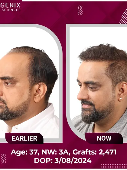 The confident smile of this 37-year-old after his 2471-graft procedure says it all.