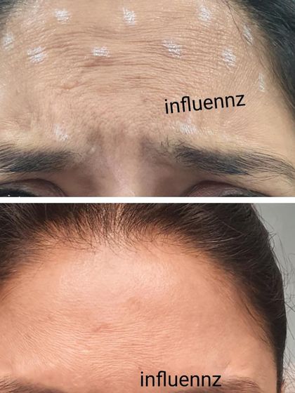 Another example of a patient's journey with Botox. The white dots show the injection points, and the after photo reveals a significantly smoother forehead.