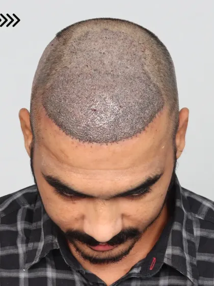 The process begins with precise planning. Here you can see the pre-marked area for a Grade 5A case before we implanted 3,800 grafts.