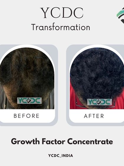 A fantastic transformation achieved with Growth Factor Concentrate (GFC). This image shows a clear improvement in hair quality, density, and coverage after just three months of treatment.