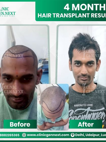 In only 4 months, this patient is already seeing a new look and a boost in confidence. This early-stage growth is a great sign of the dense, natural hair to come.