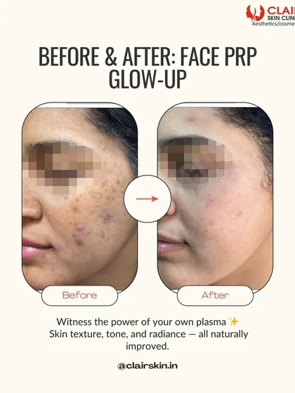 Witness a complete skin glow-up with our Face PRP treatment. By using your body's own plasma, we naturally improve skin texture, tone, and radiance, effectively reducing blemishes and signs of dullness for a truly refreshed look.