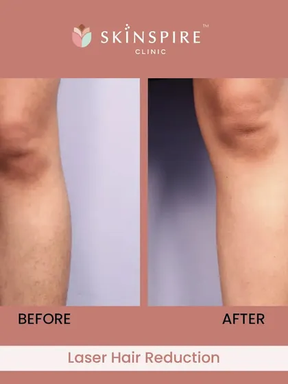 The results speak for themselves. This before-and-after image shows the significant reduction in hair growth and improved skin texture after a course of laser hair reduction sessions. Our goal is to provide a permanent solution to unwanted hair, eliminating the need for constant waxing or shaving.