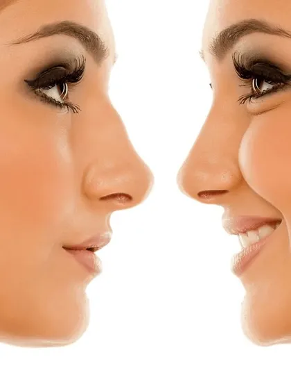 This image shows the powerful change in a person's profile after rhinoplasty. My goal is always to create a natural result that complements your other facial features, enhancing your confidence.