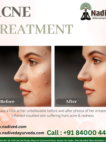 This before-and-after image shows the transformative effect of my Ayurvedic acne treatment. I focus on balancing the body internally to clear irritated, inflamed, and troubled skin, leading to a clear and radiant complexion without harsh chemicals.