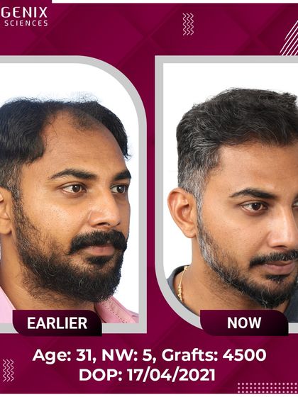 This 31-year-old patient's journey from Grade 5 hair loss to happiness with 4500 grafts.