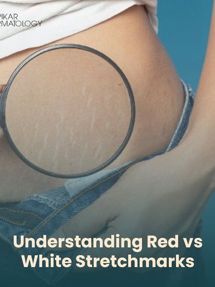 Stretch marks are a common concern, and understanding the difference between red (new) and white (old) marks is the first step. This image helps identify which type you may have, as the treatment approach differs for each.