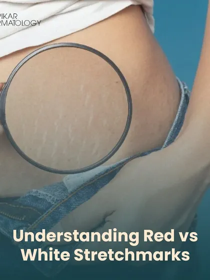 Stretch marks are a common concern, and understanding the difference between red (new) and white (old) marks is the first step. This image helps identify which type you may have, as the treatment approach differs for each.