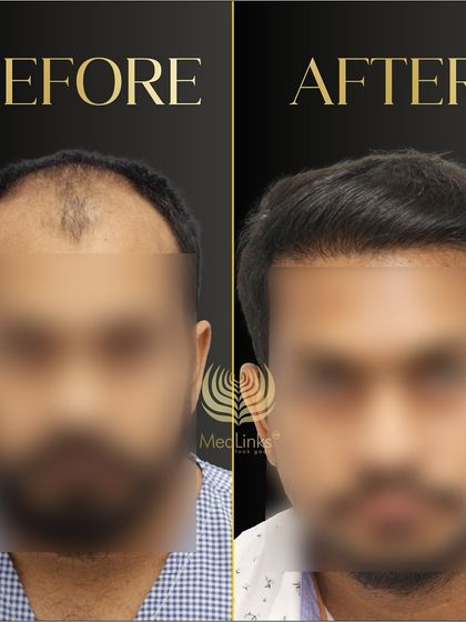 This before and after comparison, with the patient's face blurred, still clearly shows the dramatic and positive change from the hair transplant.