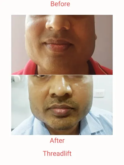 A before-and-after of a male client who underwent a threadlift for cheek lifting and tightening. The result is a subtly lifted mid-face and a more defined jawline, enhancing the facial structure.
