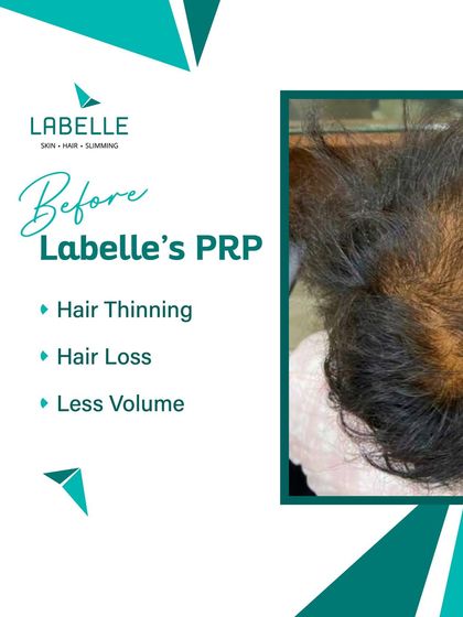 LaBelle - Hair Loss Treatment & Restoration Real Results: Before & After Gallery photo 5