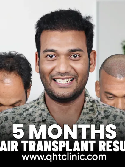 A 5-month update showing visible growth and a confidence boost. We implanted 3300 grafts to reconstruct the hairline and cover the mid-scalp.