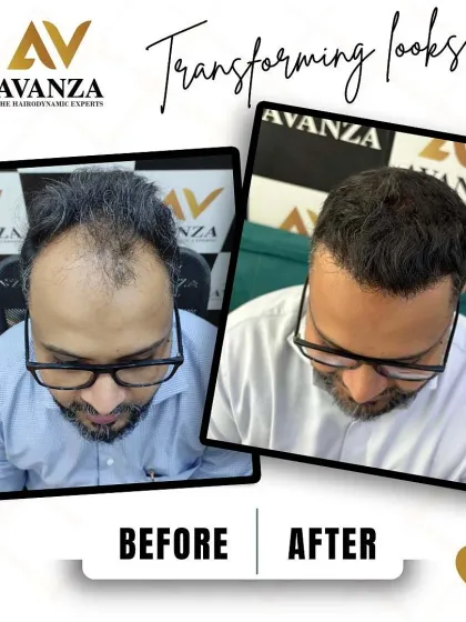 Dnyanraj’s journey from thinning hair to a full, natural look. This result was achieved through meticulous graft placement to ensure even density and a seamless blend.