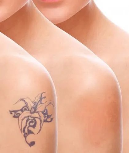 This image illustrates the gradual fading process of laser tattoo removal over multiple sessions. The laser breaks down the ink, and the body's natural processes clear it away over time. This visual represents the expected progression towards clear skin.