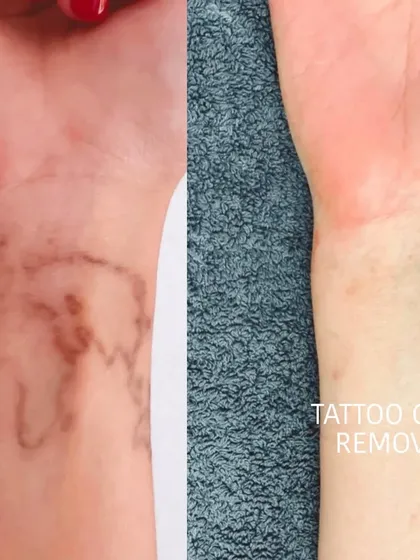 This shows the removal process for a brown ink tattoo on the wrist. Different ink colors and types require slightly different approaches, but the goal is always clear skin.