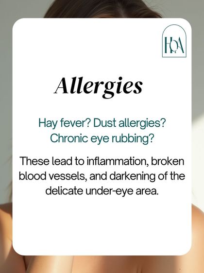 Do you suffer from allergies? Chronic eye rubbing from hay fever or dust allergies leads to inflammation, broken blood vessels, and a darkening of the delicate under-eye skin, contributing to the appearance of dark circles.