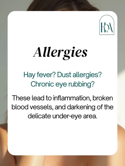 Do you suffer from allergies? Chronic eye rubbing from hay fever or dust allergies leads to inflammation, broken blood vessels, and a darkening of the delicate under-eye skin, contributing to the appearance of dark circles.