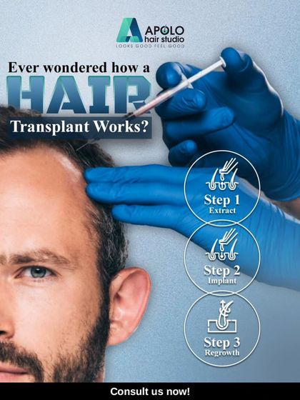This graphic simplifies the hair transplant process into three core steps. We first extract healthy follicles, then implant them into the target areas, and finally, you watch your own natural hair regrow.