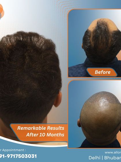 These images show the remarkable results after 10 months, including the planning stage. It's a clear demonstration of how careful planning leads to a successful and natural-looking outcome.