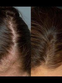 Hair Restoration & Scalp Treatments