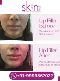 Lip Enhancement & Tattoo Removal
