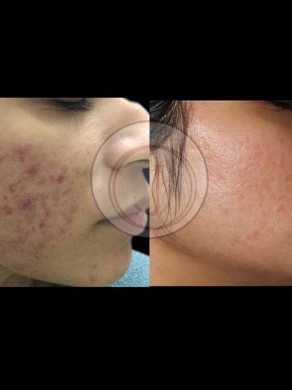 For severe inflammatory acne, I often combine medical treatments with procedures like MNRF and CO2 lasers. This patient is still on her treatment journey, but the improvement in active acne and early scarring is already significant.