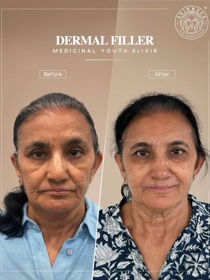 This before and after demonstrates the art of dermal fillers. My goal was to restore lost volume in the mid-face and under-eye area, which softens shadows and lifts the contours for a naturally refreshed and less tired appearance, without altering her unique features.
