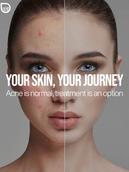 Your skin journey is unique. While acne is a normal part of many people's lives, effective medical treatment is an option to regain control and confidence.