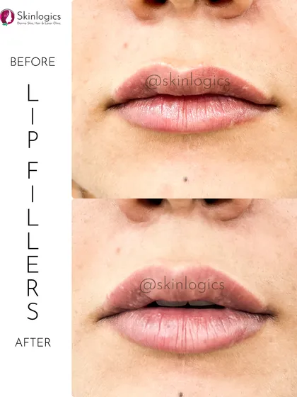 A clear example of how I approach lip fillers. The goal is always a natural enhancement, adding subtle volume and definition to create a balanced and hydrated look, not an overdone pout. This before-and-after shows a beautifully refreshed and defined lip shape.