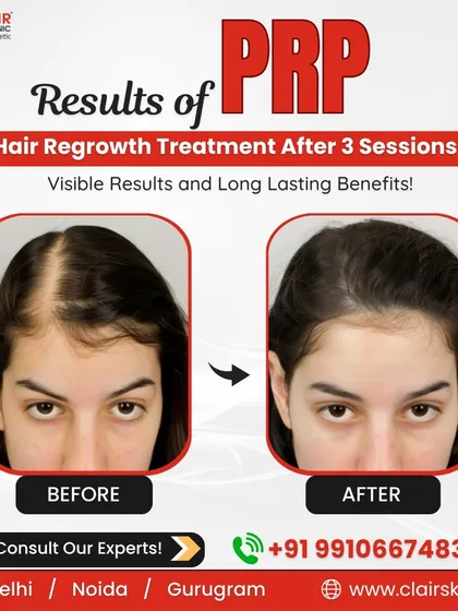 This before and after comparison shows the visible increase in hair density and scalp coverage for a client after just three sessions of our PRP hair regrowth treatment. The result is thicker, healthier hair and a significant reduction in visible thinning.