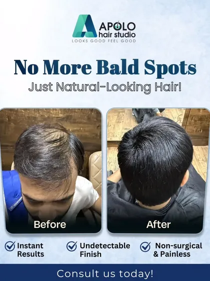 This top-down view clearly shows how we eliminate bald spots. The client's thinning crown is completely covered with a custom hair patch, resulting in an undetectable finish that is both non-surgical and painless.