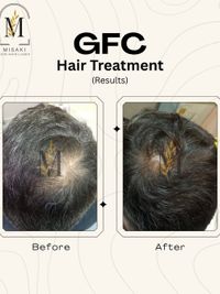 Hair Restoration