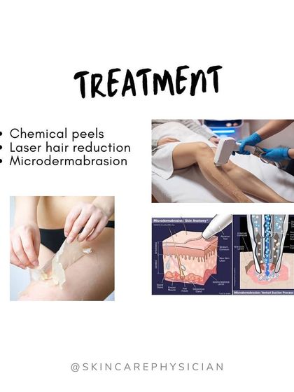 For persistent keratosis pilaris, I may recommend in-office treatments. Procedures like chemical peels, laser hair reduction, and microdermabrasion can help smooth the bumps and reduce associated redness.