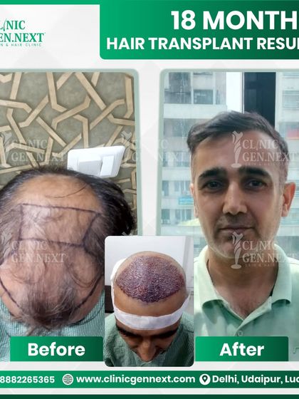 This is a fantastic transformation after 18 months using my Hybrid-DHI/FUE technique. We successfully covered a large area of baldness, achieving a dense, natural, and confident look for the patient.