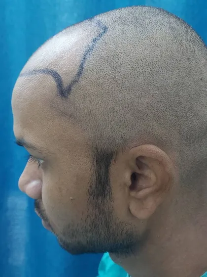 A side view of the hairline design before the FUE procedure begins. We carefully plan the placement of grafts to ensure the final result looks completely natural from every angle.