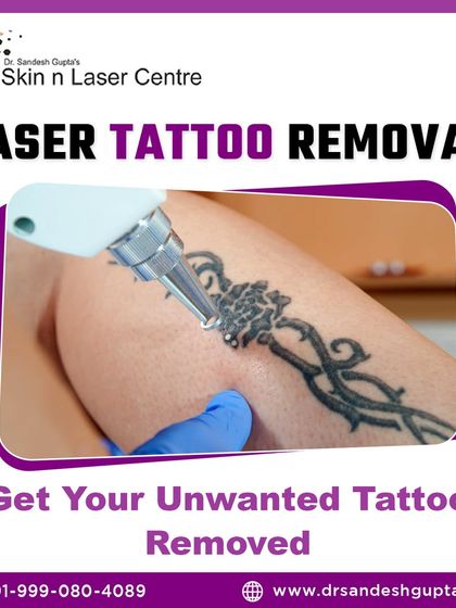 This graphic shows a laser being used for tattoo removal. We can help you safely remove unwanted tattoos under expert dermatological supervision.