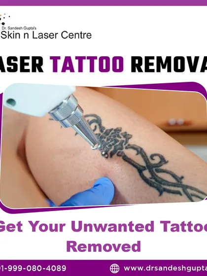 This graphic shows a laser being used for tattoo removal. We can help you safely remove unwanted tattoos under expert dermatological supervision.